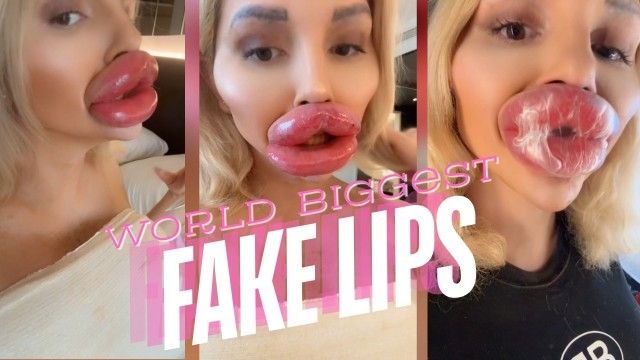Huge Injected Filler Lips